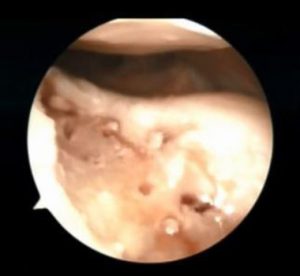 Lesione cartilaginea troclea femorale