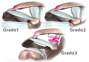 lussazione acromion claveare